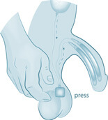 Penile implant for Erectile Dysfunction 04 2x, Dr Alistair Campbell - ED Specialist Gold Coast