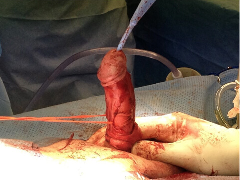 Peyronies Disease 5 Penile surgery 02, Dr Campbell Gold Coast
