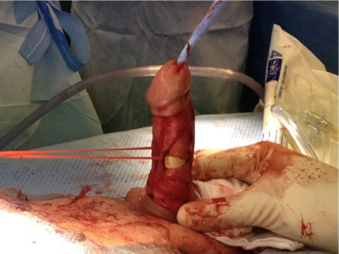 Peyronies Disease 4 Penile surgery 03, Dr Campbell Gold Coast