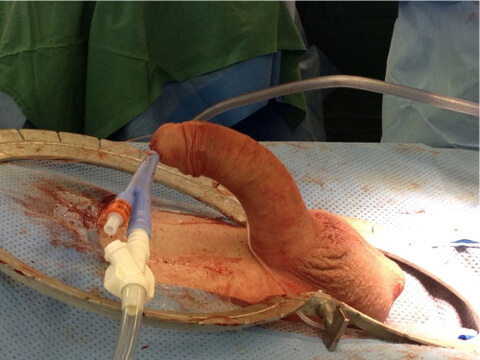 Peyronies Disease 3 Penile surgery 04, Dr Campbell Gold Coast