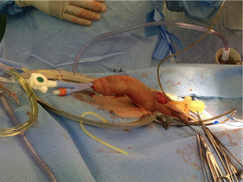 Peyronies Disease 2 Penile surgery 05, Dr Campbell Gold Coast