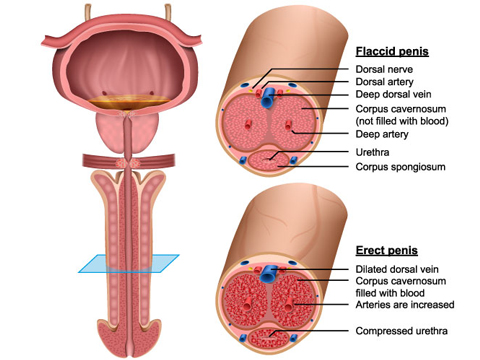 Peyronies Disease 7 Peyronie's disease illustration 06, ED Clinic