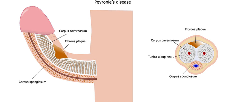 Peyronies Disease 8 Peyronie's disease illustration 07, ED Clinic